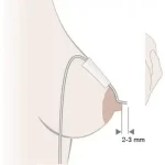 Medela Système de nutrition supplémentaire (SNS) Dispositif d'Aide à la Lactation (DAL) – Image 2